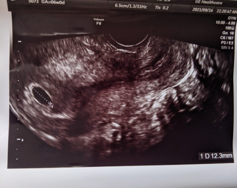 6週目 妊娠初期 胎嚢 見えない 心拍確認できない